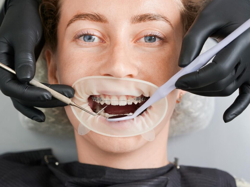 macro photography beautiful girl with braces dental clinic 651396 3441
